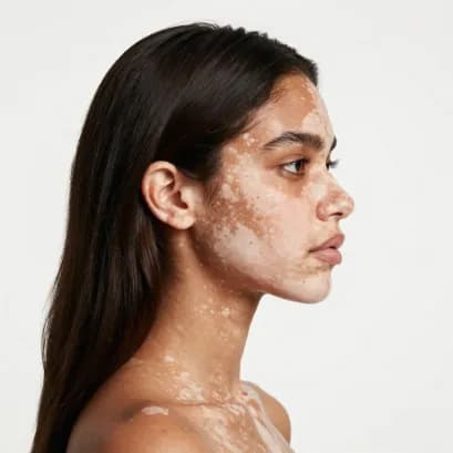 Vitiligo